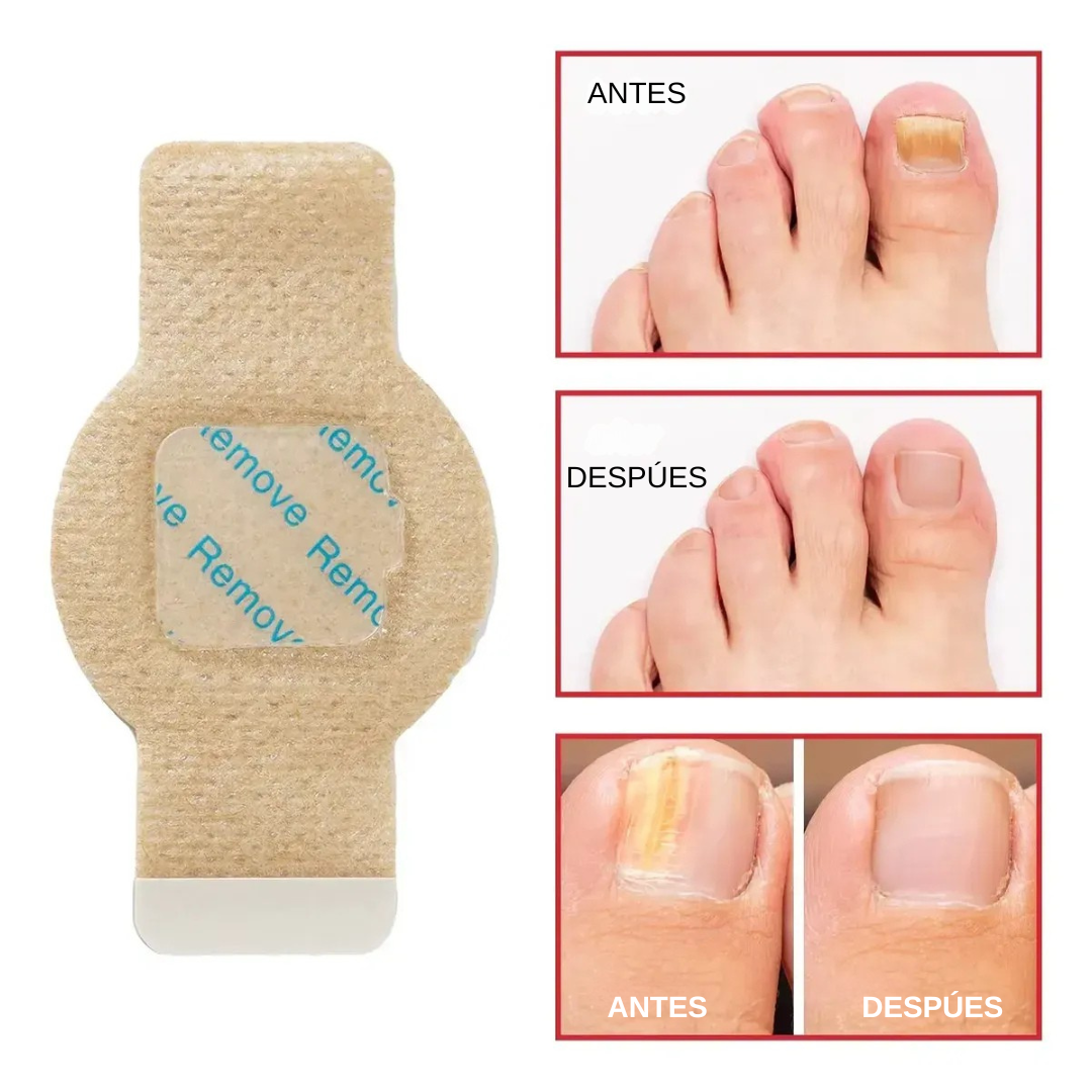 VALEUR™Parches para hongos en las uñas Resultados en 4 Semanas