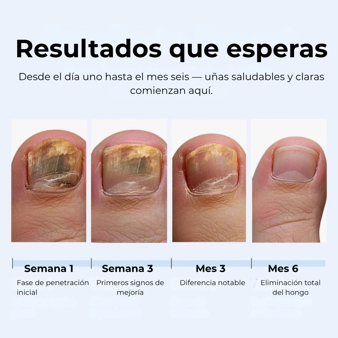 VALEUR™Parches para hongos en las uñas Resultados en 4 Semanas