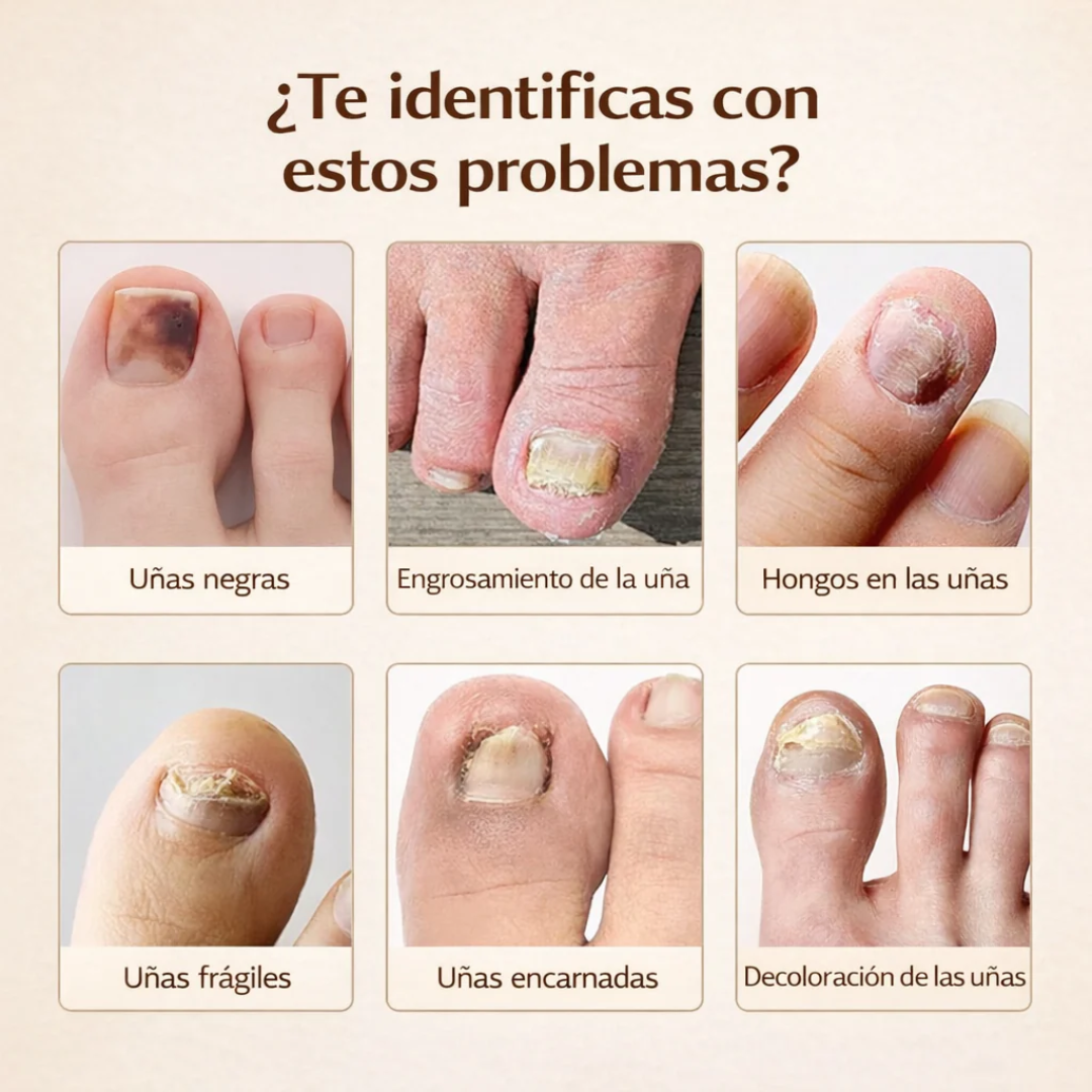 VALEUR™Parches para hongos en las uñas Resultados en 4 Semanas